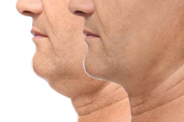 HIFU - Breakthrough in Anti - ageing 2 hifu results Wellingborough