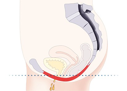 Pelvic-Floor Muscle Repair 5 Pelvic floor muscles Wellingborough