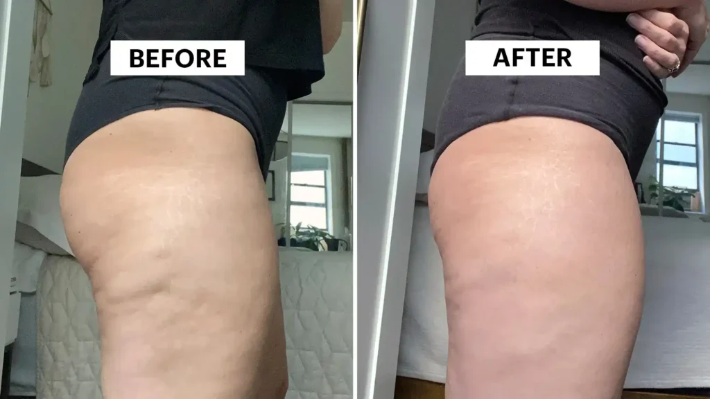 Sculpting Your Bum: Can Toning Exercises Really Reduce Cellulite? 1 Do Toning Exercise Wellingborough Really Tackle Cellulite?