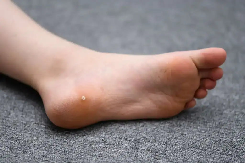Cryotherapy For Warts And Also Verrucas 2 Image of verruca on the bottom of the foot that able to be treated with Cryotherapy Wellingborough