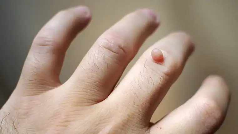 Cryotherapy For Warts And Also Verrucas 1 Image of blemish that Cryotherapy Wellingborough can remove with Lipo 360.
