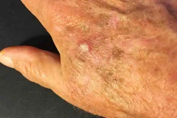 Image of Actinic keratoses Wellingborough on a person hand