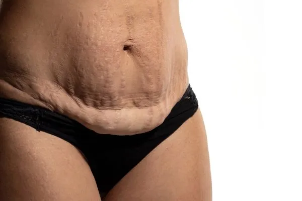The Science of Skin Tightening 1 The science behind skin tightening Wellingborough picture of a woman's sagging skin on the stomach
